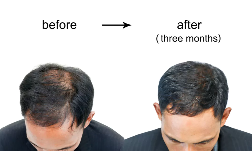 Best Hair Loss Treatments for Men 12