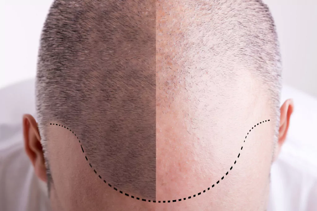 The Ultimate Guide To Hair Transplants 7