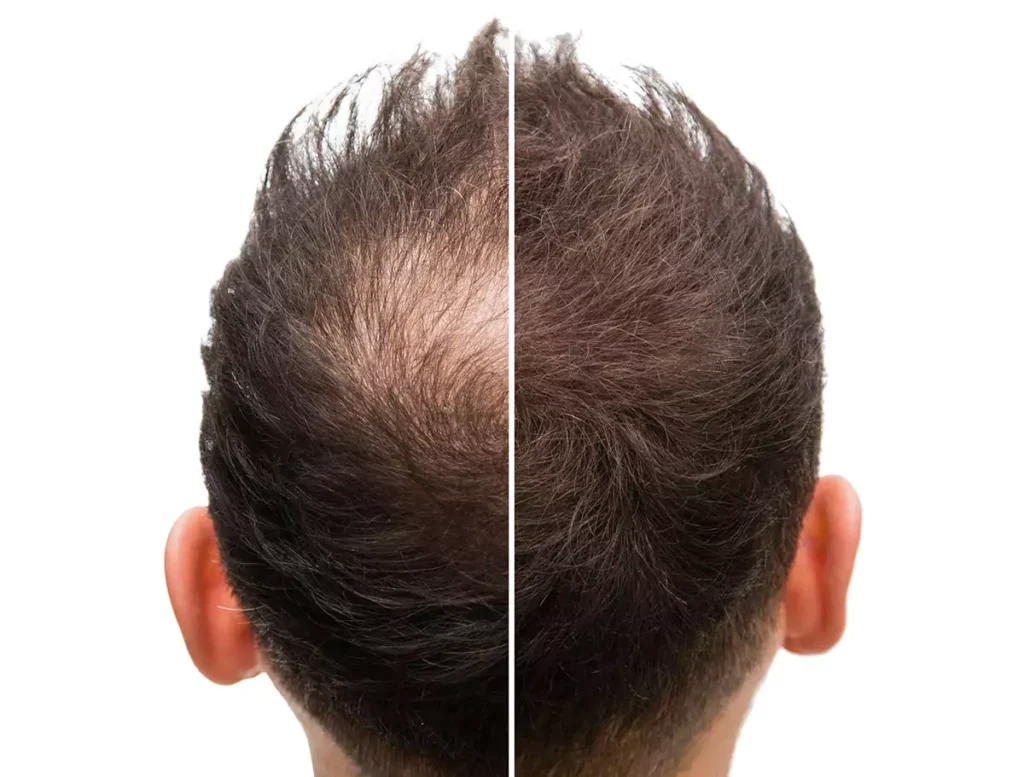 Revitalise Your Hair: The Ultimate Guide to PRP Hair Loss Treatment in London 2